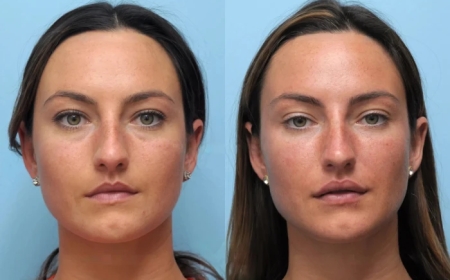 Redefine Beauty with the Best Aesthetic Clinics in Dubai for Thread Lift