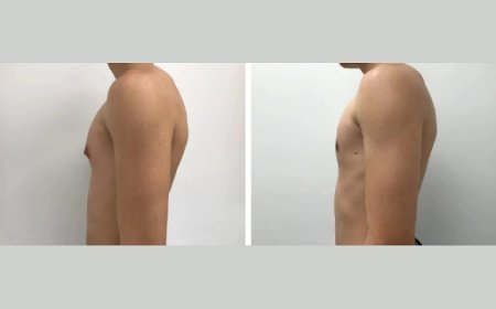 Latest Advances in Gynecomastia Surgery in Dubai