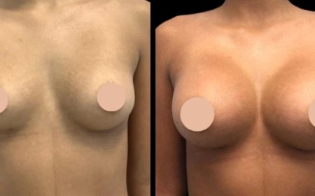 Your Journey Starts Here: Breast Augmentation Surgery in Dubai