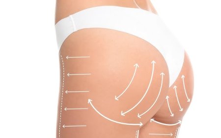 How to Ensure Natural and Stunning Results with the Best Butt Fat Transfer Surgeons in Dubai