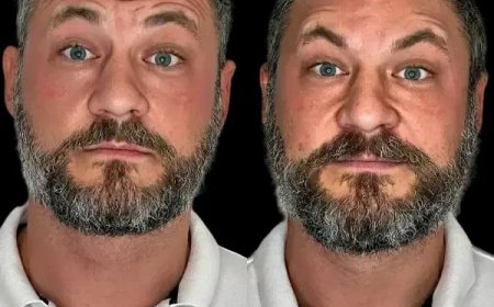 Initiate Elegance through Profhilo at the Best Aesthetic Clinic in dubai