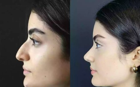 The Best Rhinoplasty Surgeons in Dubai Talk Trends in Cosmetic Surgery