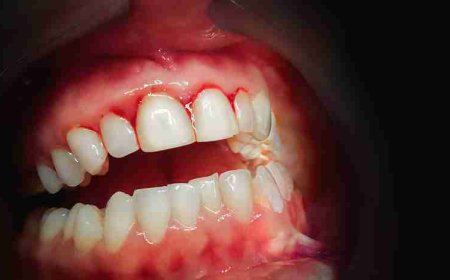 The Role of a Periodontist in Treating Bleeding Gums