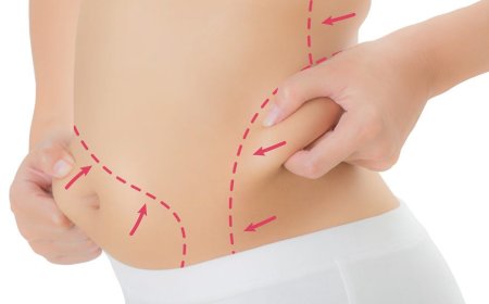 Stunning Lipo Surgery Results with Best Liposuction Doctors in Dubai