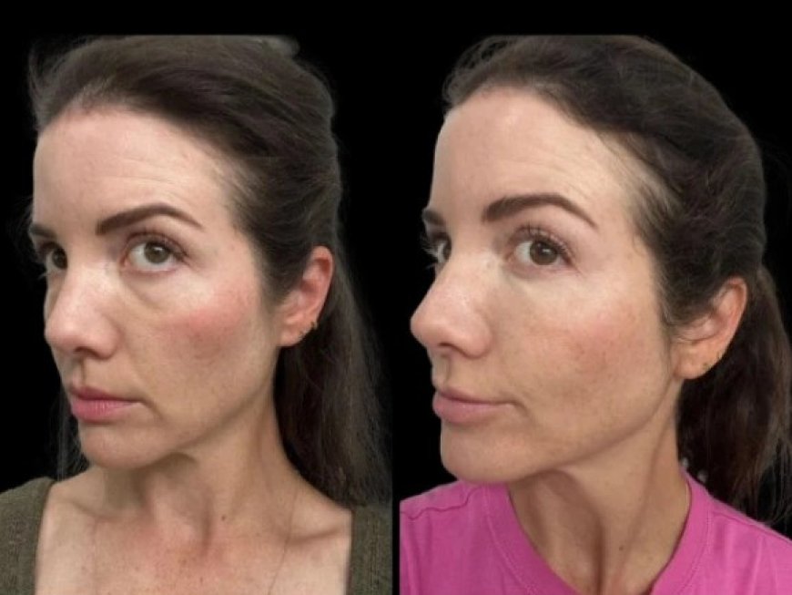 Dark Circles Treatment in Dubai: The Benefits of Chemical Peels for Under-Eye Area